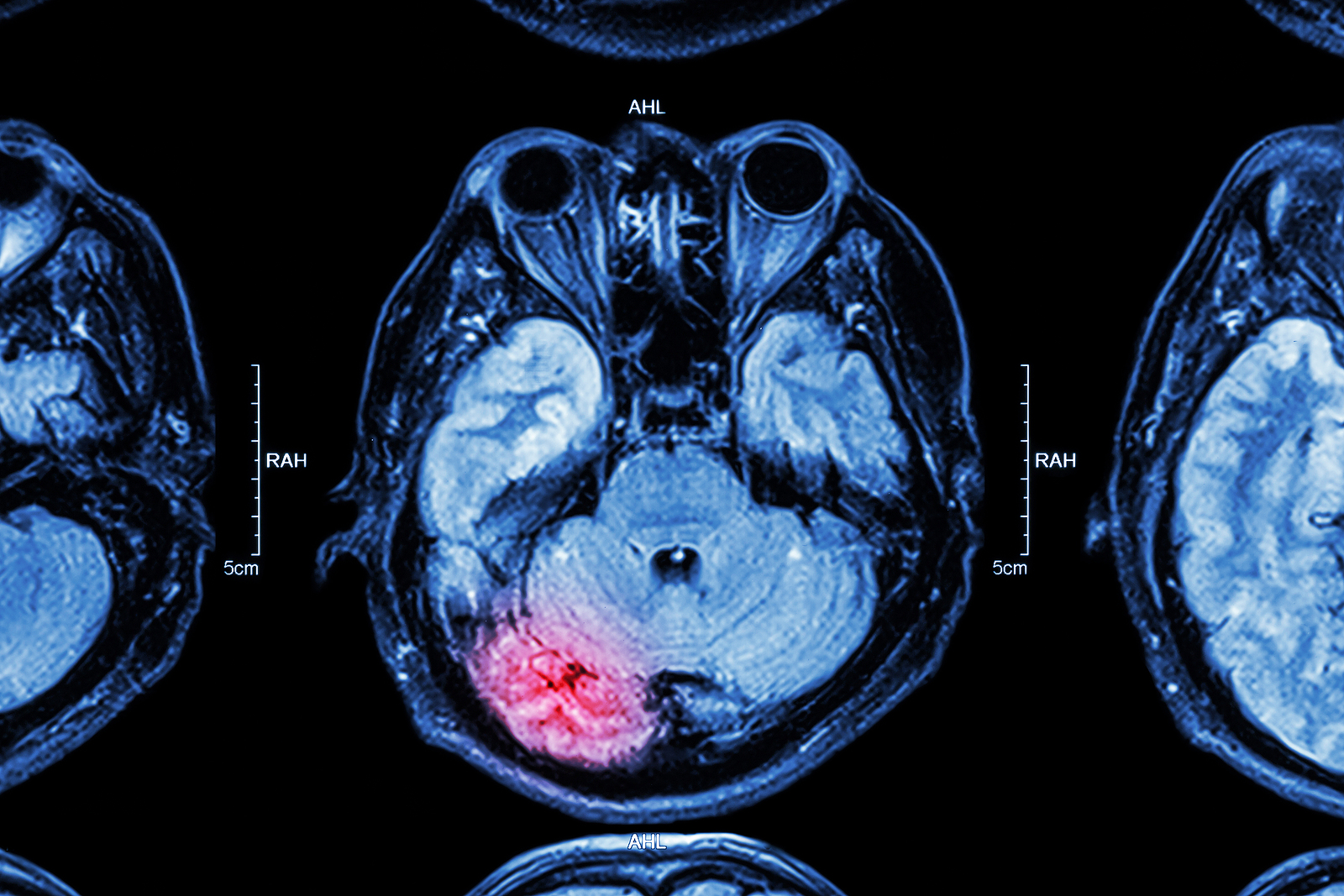 anoxic brain injury